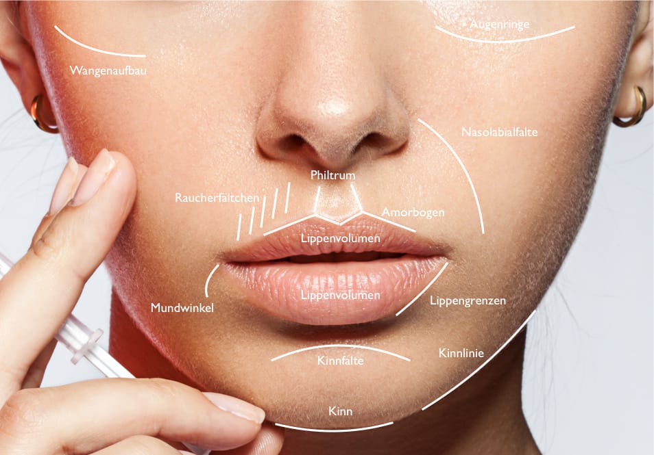 Hyaluronsäure Spritze_Fullface mit Hyaluron